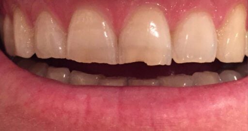 Smile case 2 before treatment
