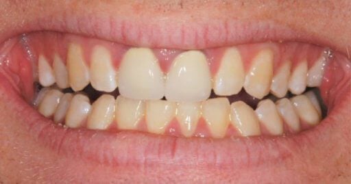 Smile case 3 before treatment